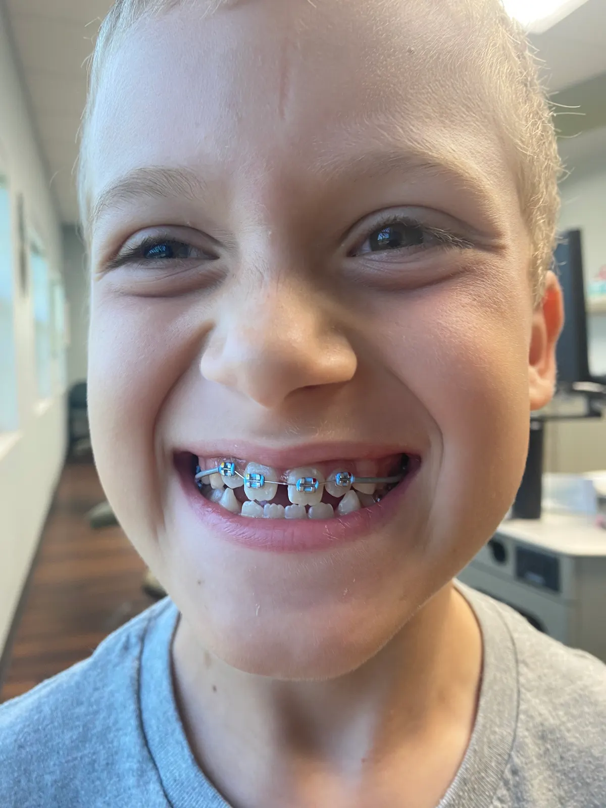 Got my braces on